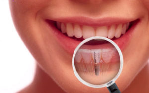 Dental-implants-dentalbees