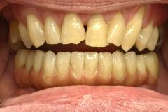 implant-dumfries-1-scaled