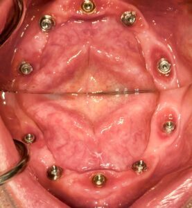 All-on-4, All-on-6, and same-day teeth solutions